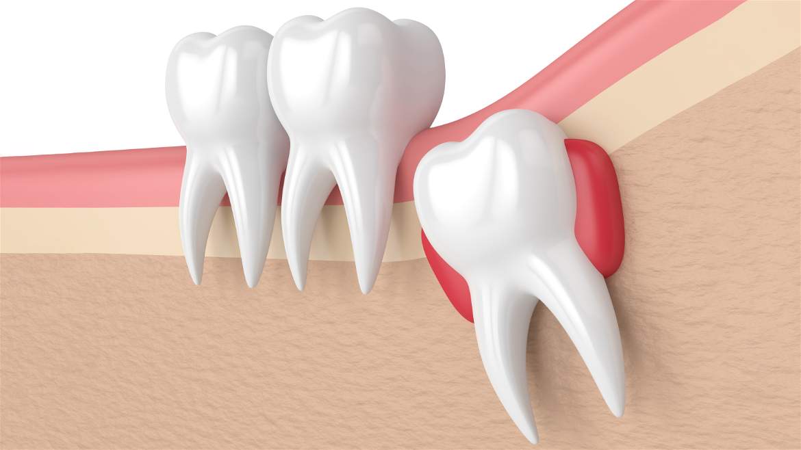 Dentes do siso: quando devem ser mantidos e quando precisam ser extraídos