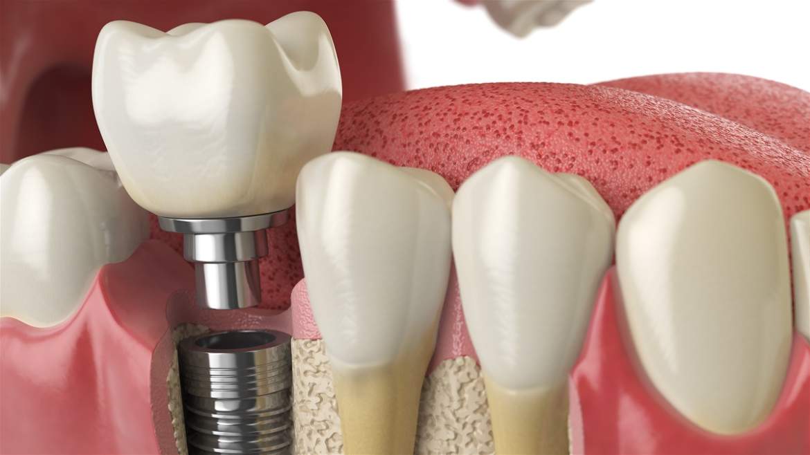 Principais dúvidas sobre implante dentário.
