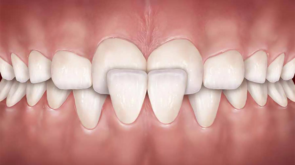 Mordida cruzada (anterior ou posterior)