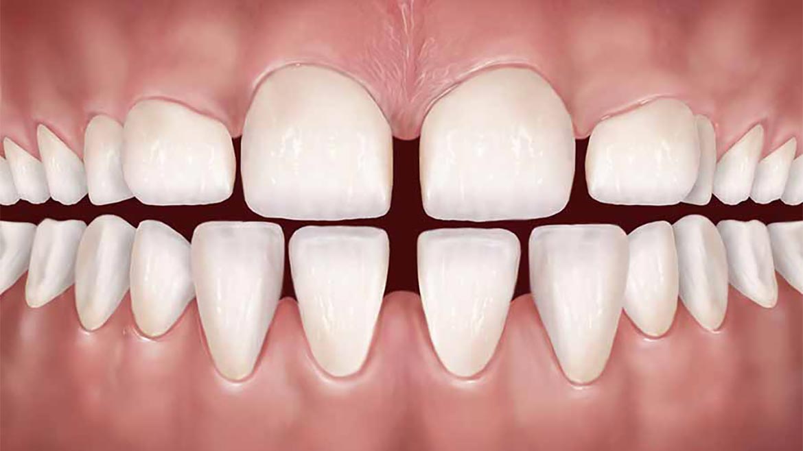 Espaçamento excessivo (diastemas generalizados)