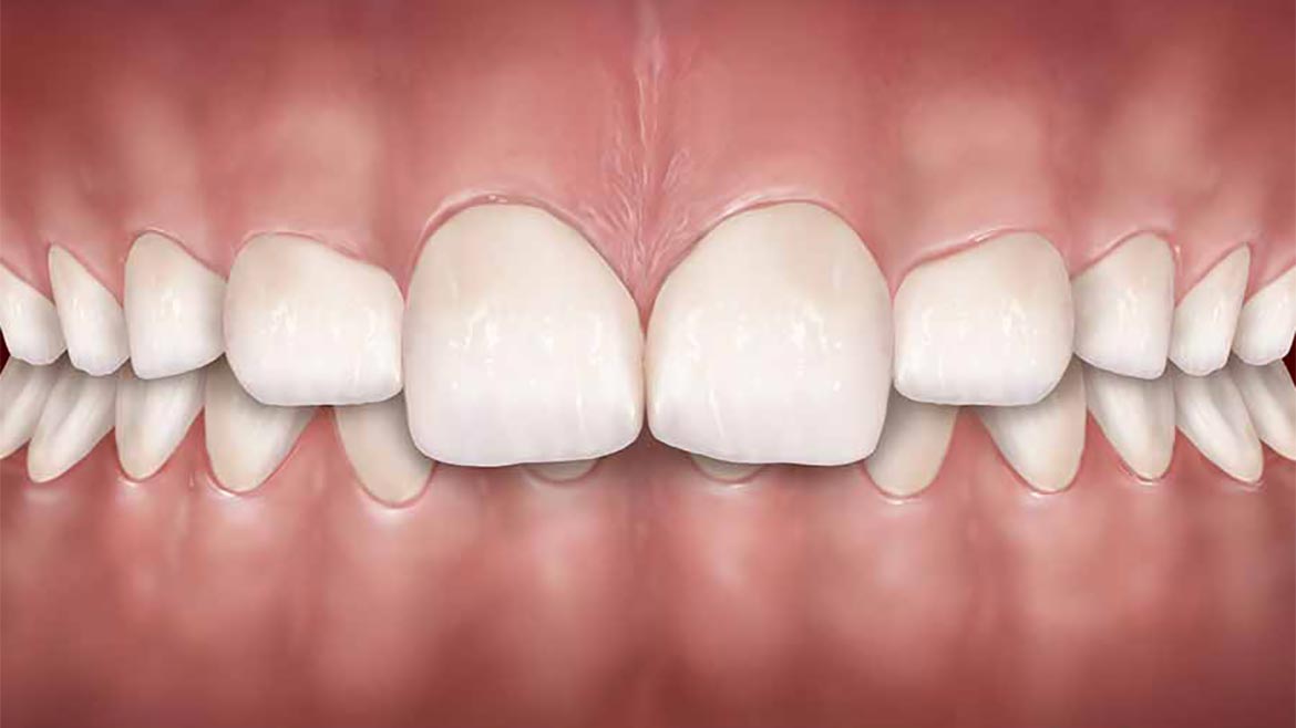 Mordida Profunda (Sobremordida Exagerada)