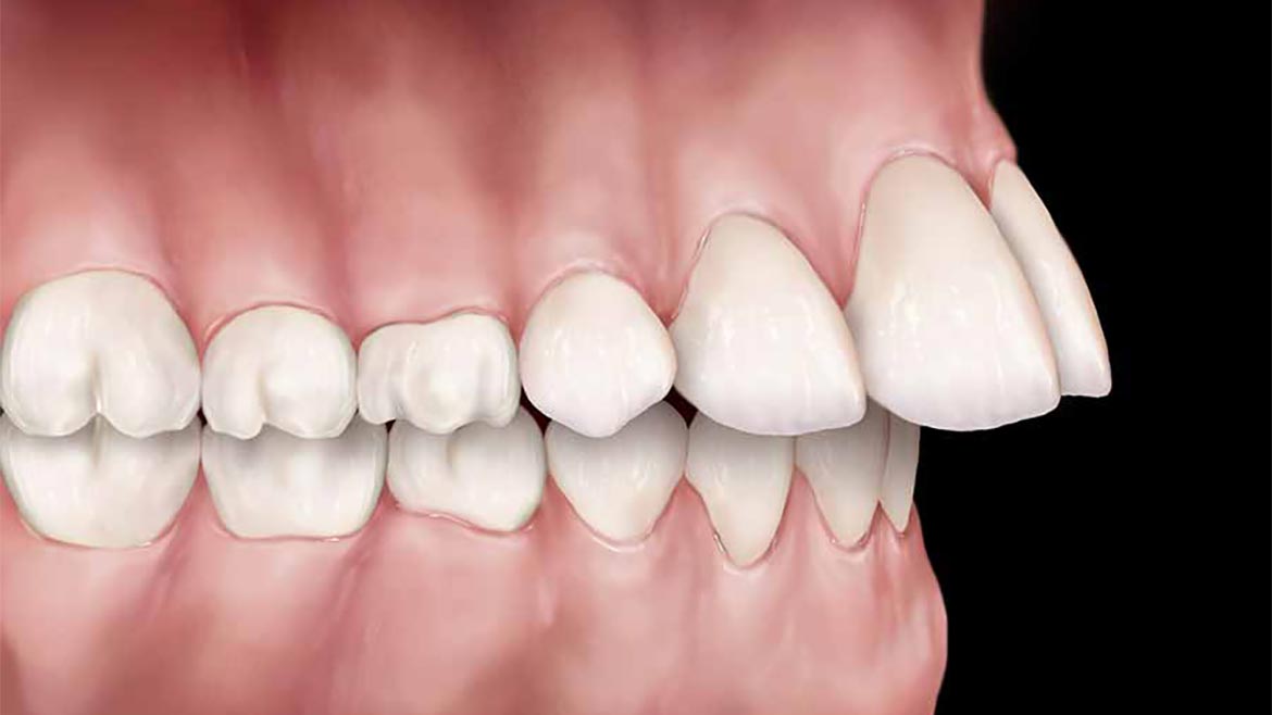 Protrusão (ou Sobressaliência aumentada)