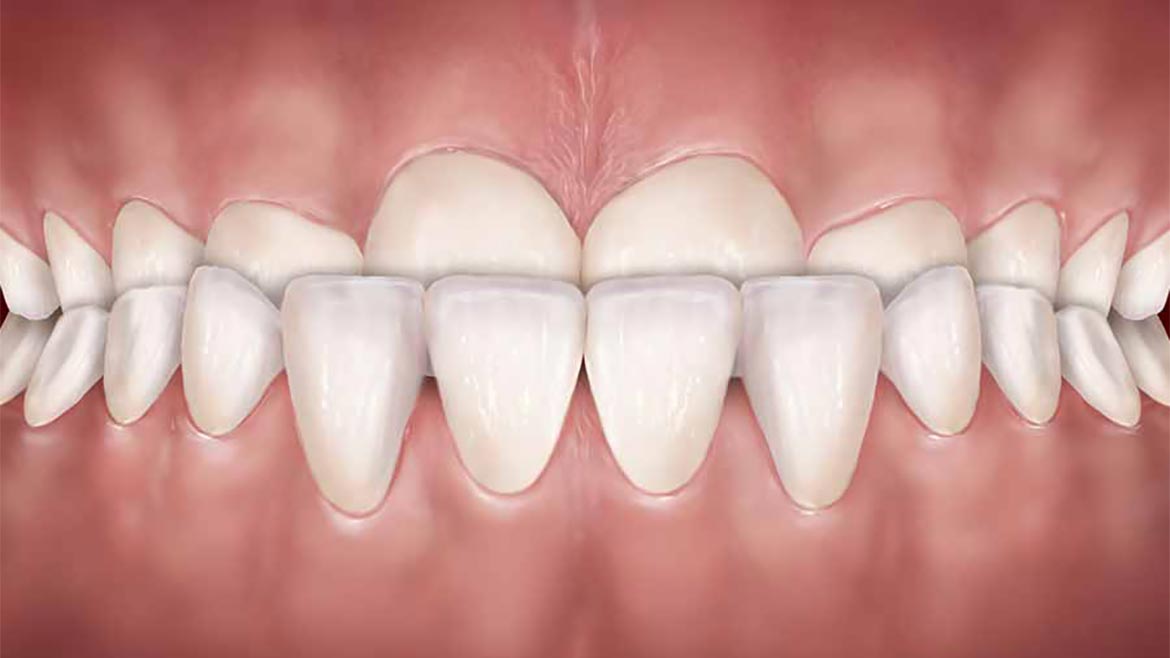 Mordida Cruzada Anterior Total 